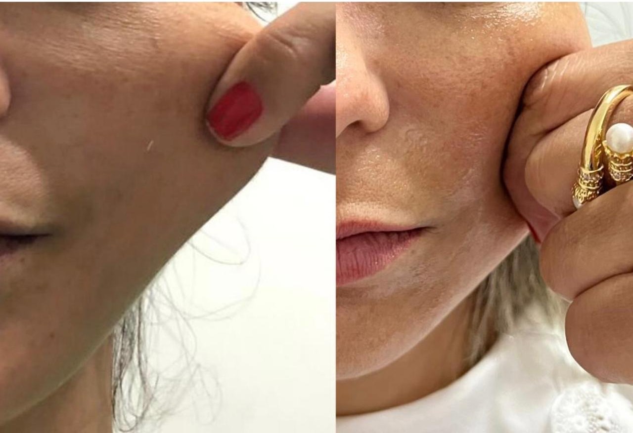 Bioestimuladores