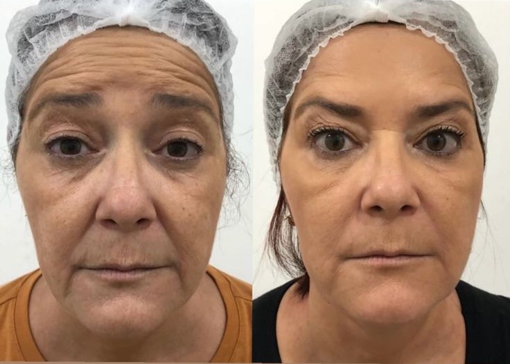 Harmonização Facial