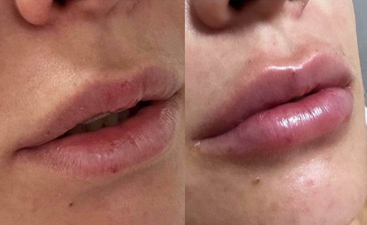Preenchimento Labial